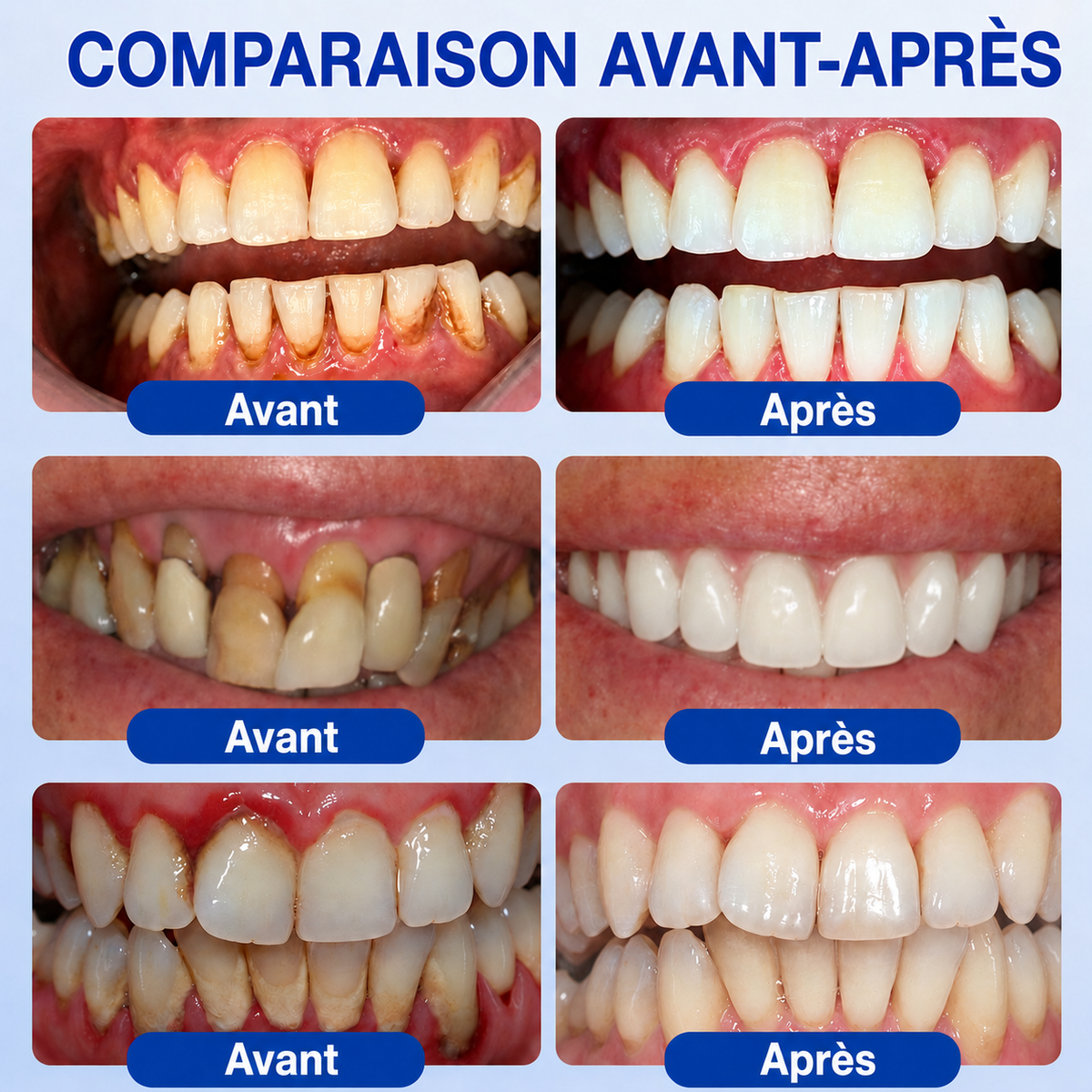 🧑‍⚕️🍃🦷GarageLine® GumRevive Gel réparateur parodontal
