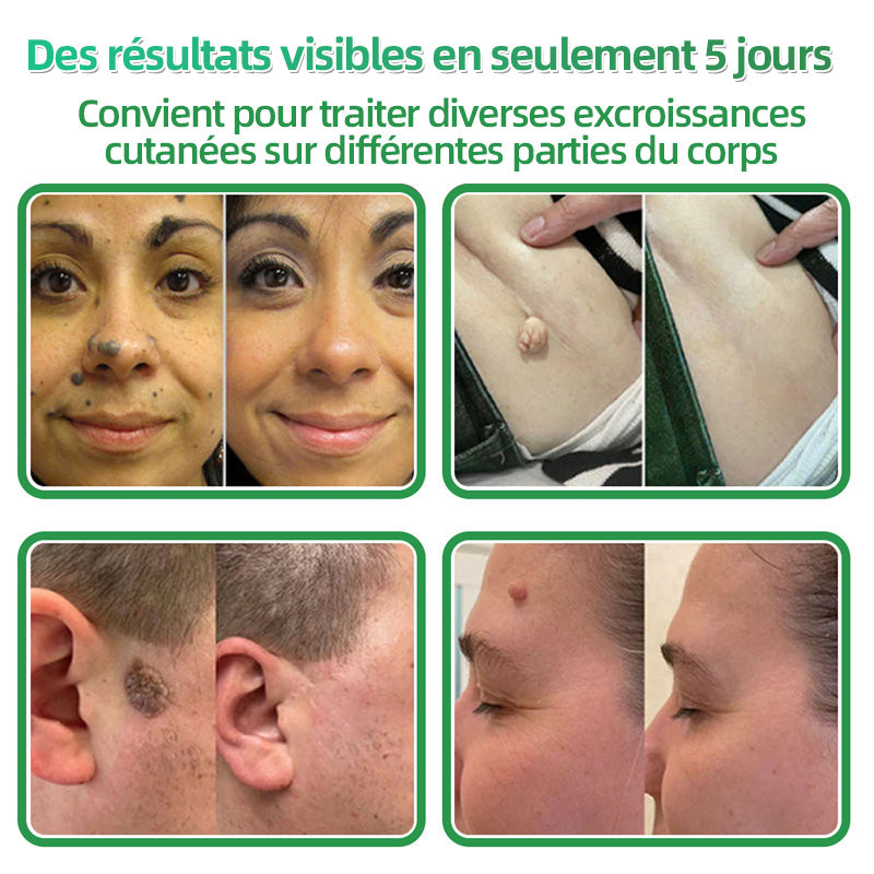 👩🏻‍⚕️Patchs hydrocolloïdes à micro-aiguilles 2 en 1 Hudros® | Élimine les grains de beauté en relief, l'acné, les verrues planes et les acrochordons | Patchs invisibles pour le visage et le corps | 144 patchs