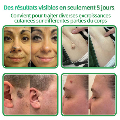 👩🏻‍⚕️Patchs hydrocolloïdes à micro-aiguilles 2 en 1 Hudros® | Élimine les grains de beauté en relief, l'acné, les verrues planes et les acrochordons | Patchs invisibles pour le visage et le corps | 144 patchs