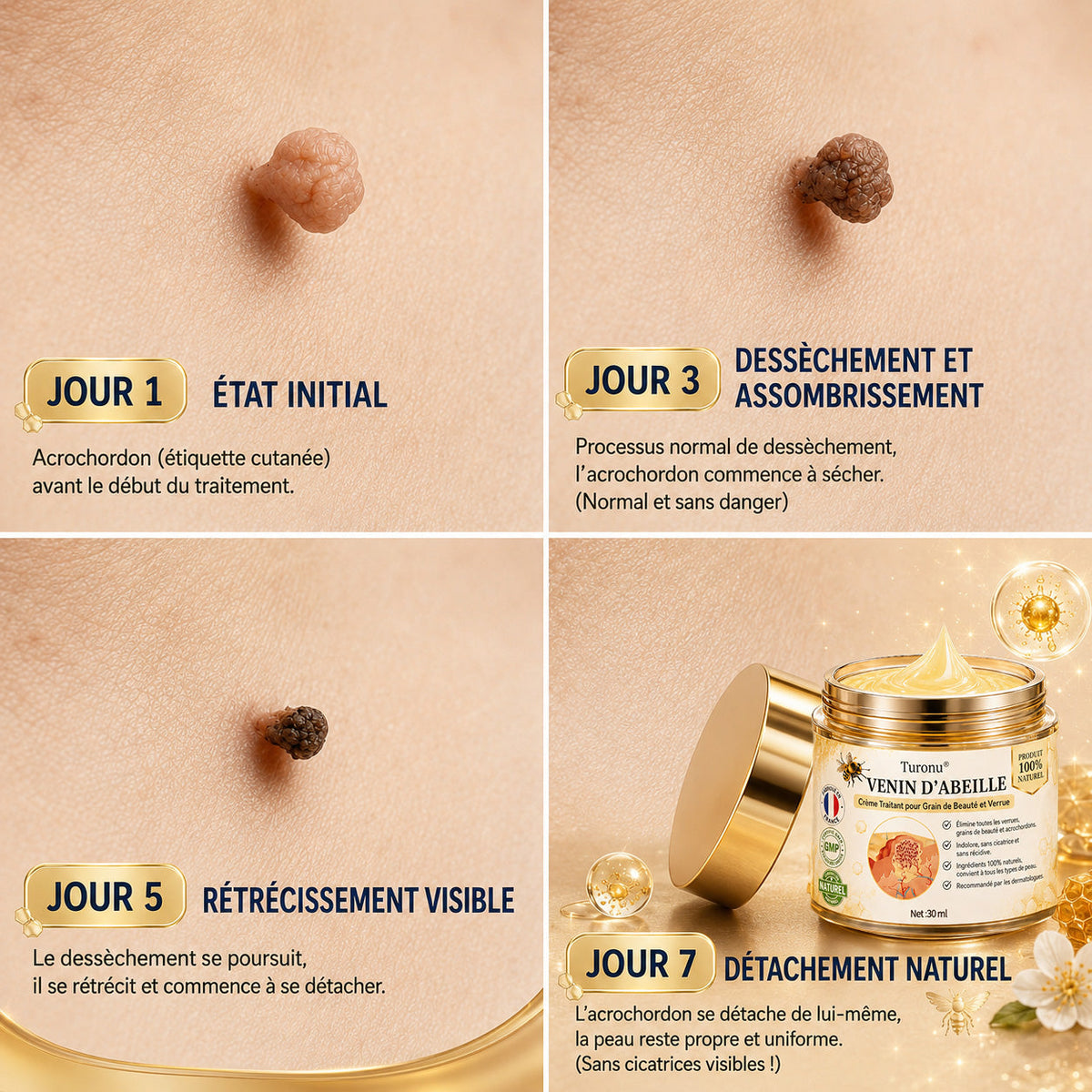 Turonu®💐 traitement avancé au venin d'abeille contre les verrues et les imperfections cutanées 👨‍⚕️ Inspiré de la science dermatologique | Soin ciblé à domicile