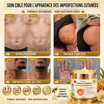 Turonu®💐 traitement avancé au venin d'abeille contre les verrues et les imperfections cutanées 👨‍⚕️ Inspiré de la science dermatologique | Soin ciblé à domicile