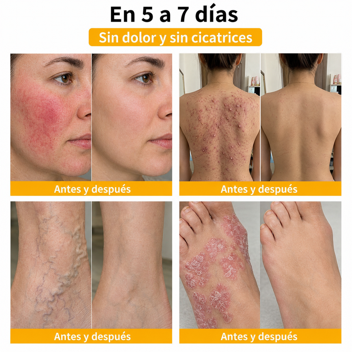 🔔Turonu® : traitement avancé au venin d'abeille contre les verrues et les imperfections cutanées 👨‍⚕️ Inspiré de la science dermatologique | Soin ciblé à domicile