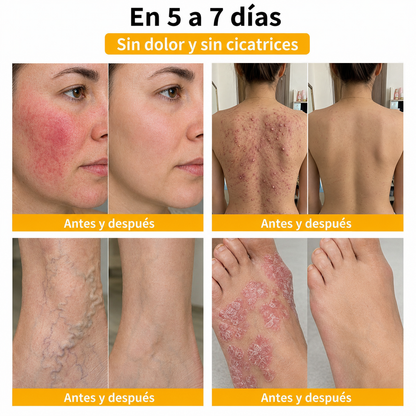 🔔Turonu® : traitement avancé au venin d'abeille contre les verrues et les imperfections cutanées 👨‍⚕️ Inspiré de la science dermatologique | Soin ciblé à domicile