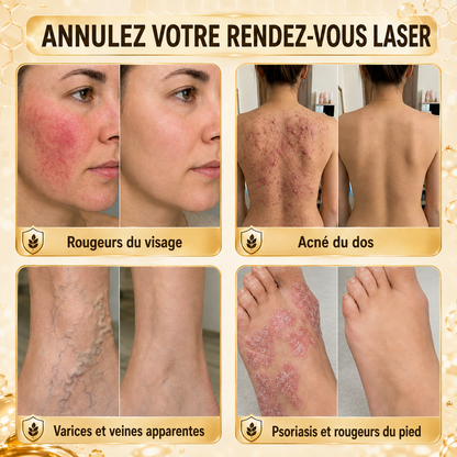 Turonu®💐 traitement avancé au venin d'abeille contre les verrues et les imperfections cutanées 👨‍⚕️ Inspiré de la science dermatologique | Soin ciblé à domicile