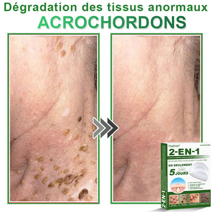 👩🏻‍⚕️Patchs hydrocolloïdes à micro-aiguilles 2 en 1 Hudros® | Élimine les grains de beauté en relief, l'acné, les verrues planes et les acrochordons | Patchs invisibles pour le visage et le corps | 144 patchs