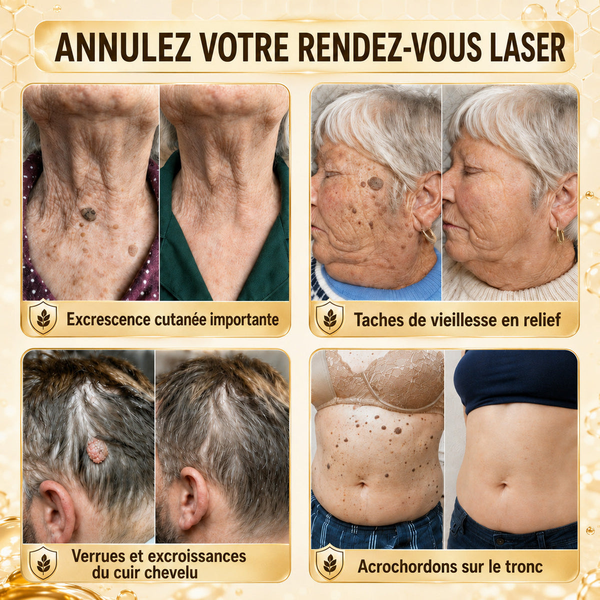 Turonu®💐 traitement avancé au venin d'abeille contre les verrues et les imperfections cutanées 👨‍⚕️ Inspiré de la science dermatologique | Soin ciblé à domicile
