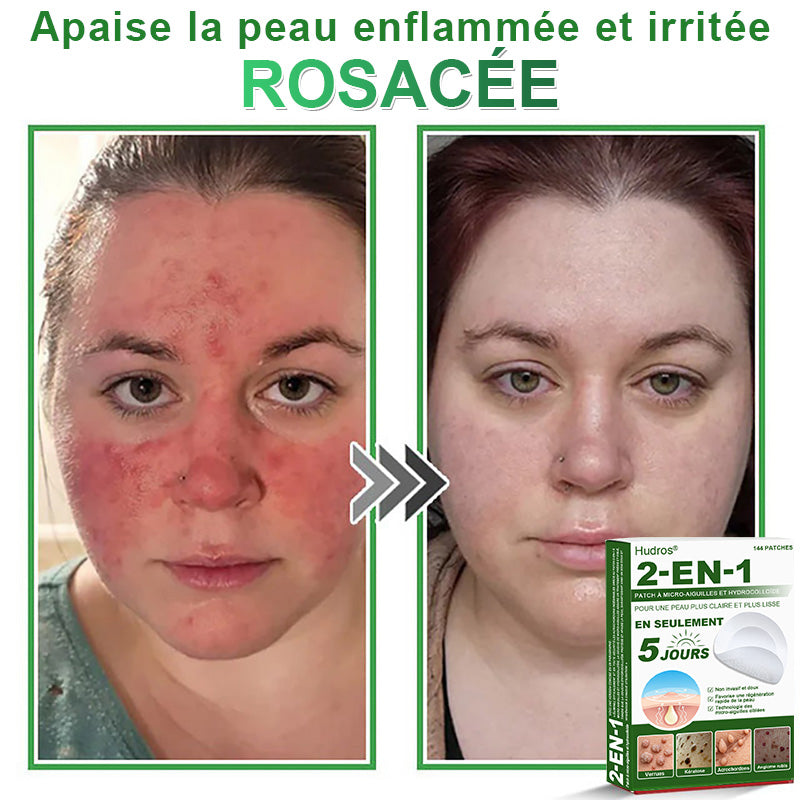 👩🏻‍⚕️Patchs hydrocolloïdes à micro-aiguilles 2 en 1 Hudros® | Élimine les grains de beauté en relief, l'acné, les verrues planes et les acrochordons | Patchs invisibles pour le visage et le corps | 144 patchs