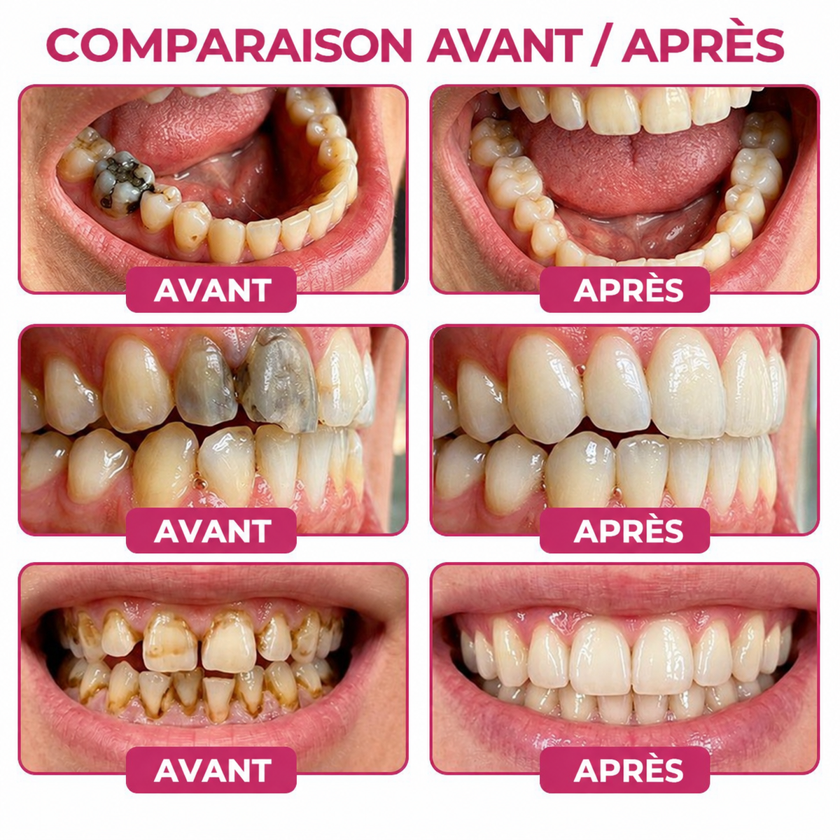 🇫🇷GarageLine® DenPerm🏆— Gel Réparateur de l’Émail Naturel pour Caries, Dents Sensibles & Émail Fragilisé