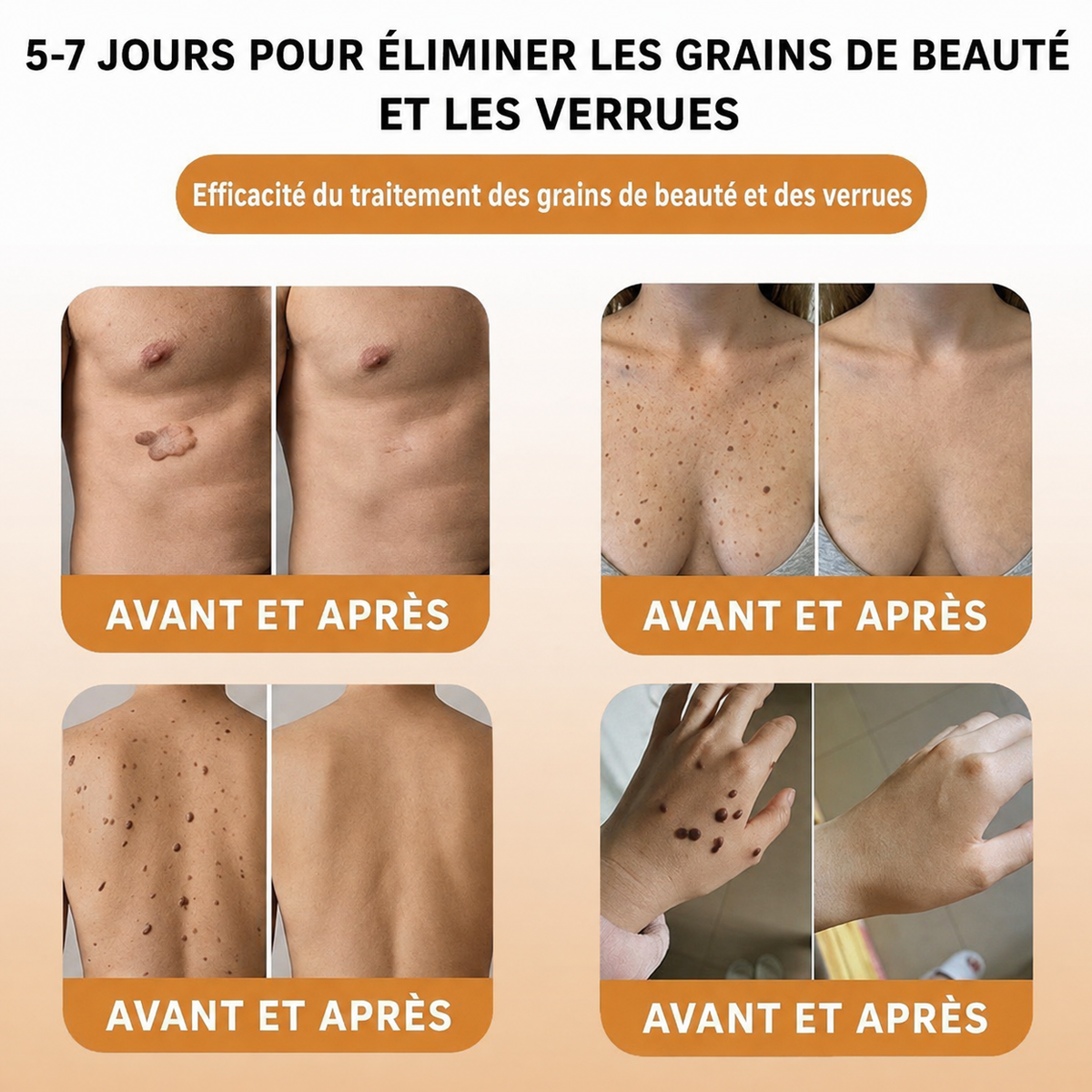 🔔Turonu® : traitement avancé au venin d'abeille contre les verrues et les imperfections cutanées 👨‍⚕️ Inspiré de la science dermatologique | Soin ciblé à domicile