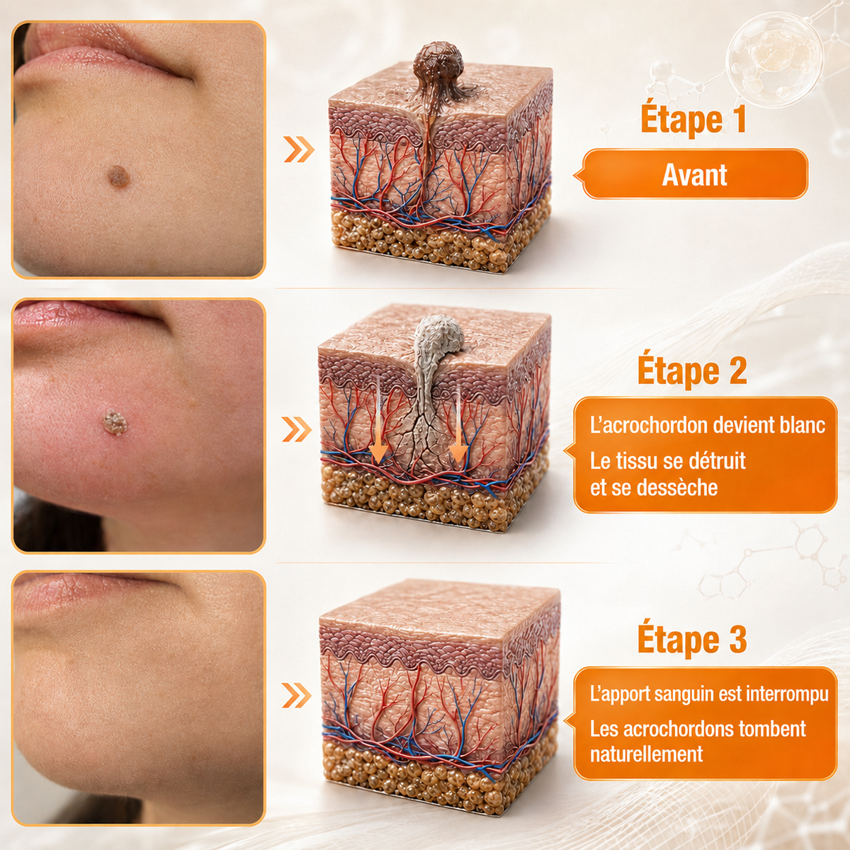 🔔Turonu® : traitement avancé au venin d'abeille contre les verrues et les imperfections cutanées 👨‍⚕️ Inspiré de la science dermatologique | Soin ciblé à domicile