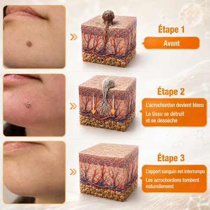 🔔Turonu® : traitement avancé au venin d'abeille contre les verrues et les imperfections cutanées 👨‍⚕️ Inspiré de la science dermatologique | Soin ciblé à domicile