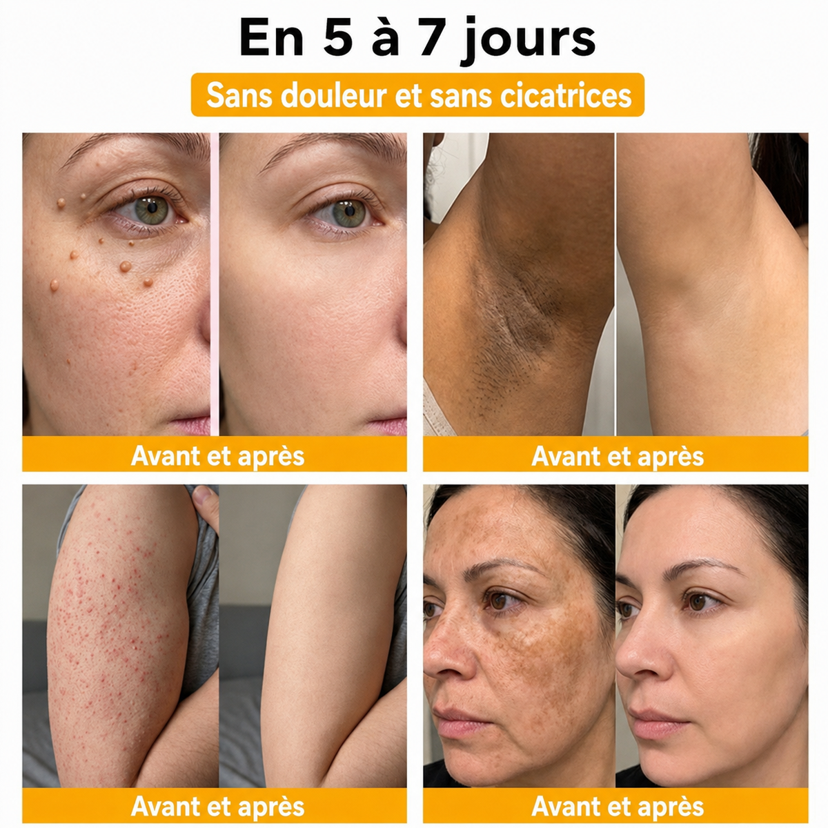 🔔Turonu® : traitement avancé au venin d'abeille contre les verrues et les imperfections cutanées 👨‍⚕️ Inspiré de la science dermatologique | Soin ciblé à domicile