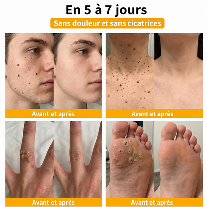 🔔Turonu® : traitement avancé au venin d'abeille contre les verrues et les imperfections cutanées 👨‍⚕️ Inspiré de la science dermatologique | Soin ciblé à domicile