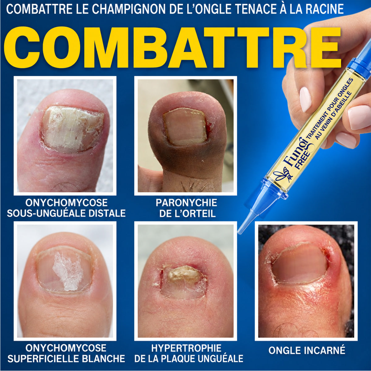 🇫🇷 Turonu® FungiFree 🐝 Soin Intensif contre les Mycoses, les Ongles Jaunis, Épais et Cassants ✨
