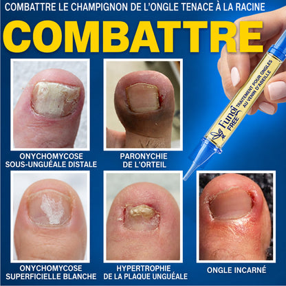 🇫🇷 Turonu® FungiFree 🐝 Soin Intensif contre les Mycoses, les Ongles Jaunis, Épais et Cassants ✨