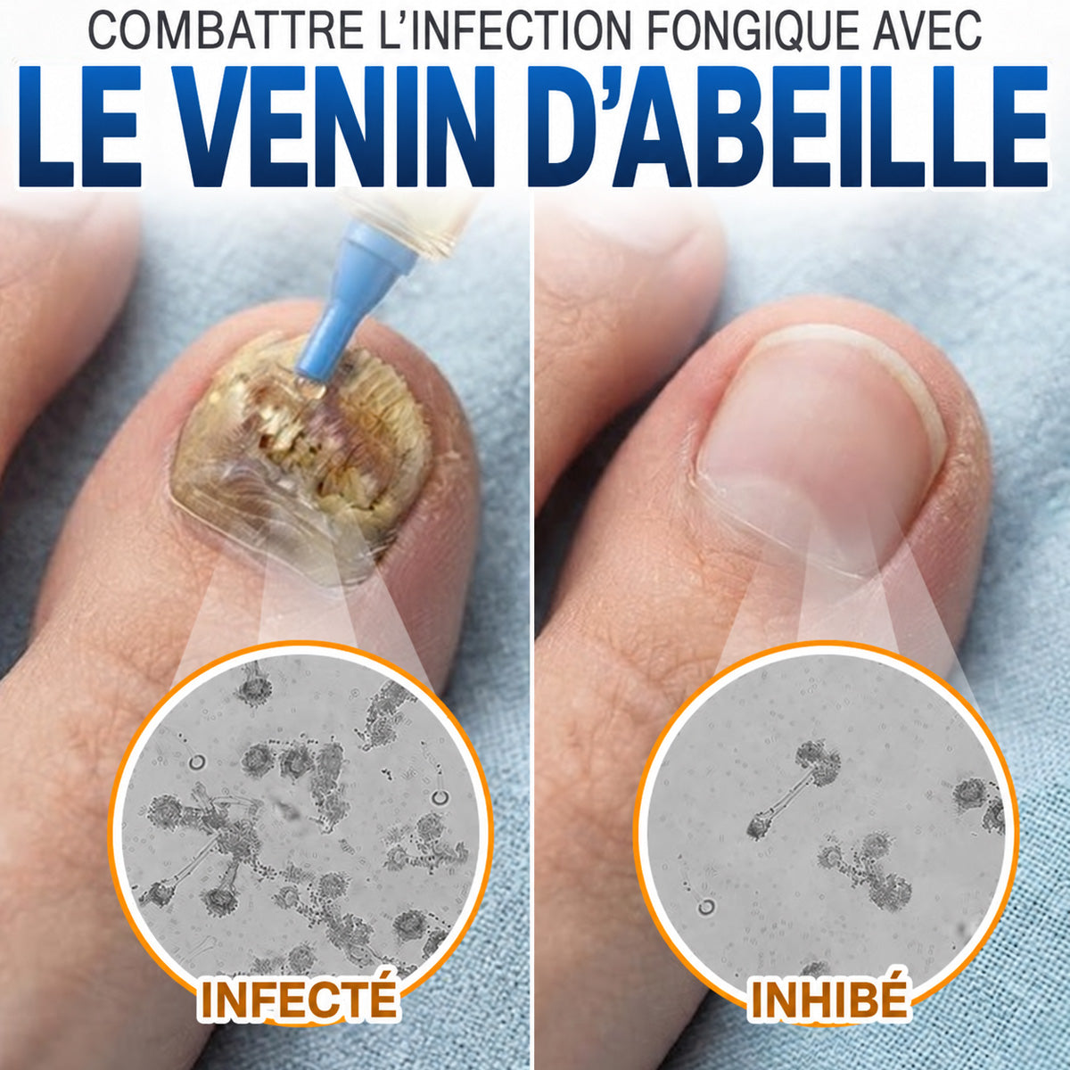 🇫🇷 Turonu® FungiFree 🐝 Soin Intensif contre les Mycoses, les Ongles Jaunis, Épais et Cassants ✨