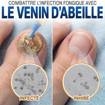 🇫🇷 Turonu® FungiFree 🐝 Soin Intensif contre les Mycoses, les Ongles Jaunis, Épais et Cassants ✨