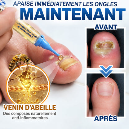🇫🇷 Turonu® FungiFree 🐝 Soin Intensif contre les Mycoses, les Ongles Jaunis, Épais et Cassants ✨