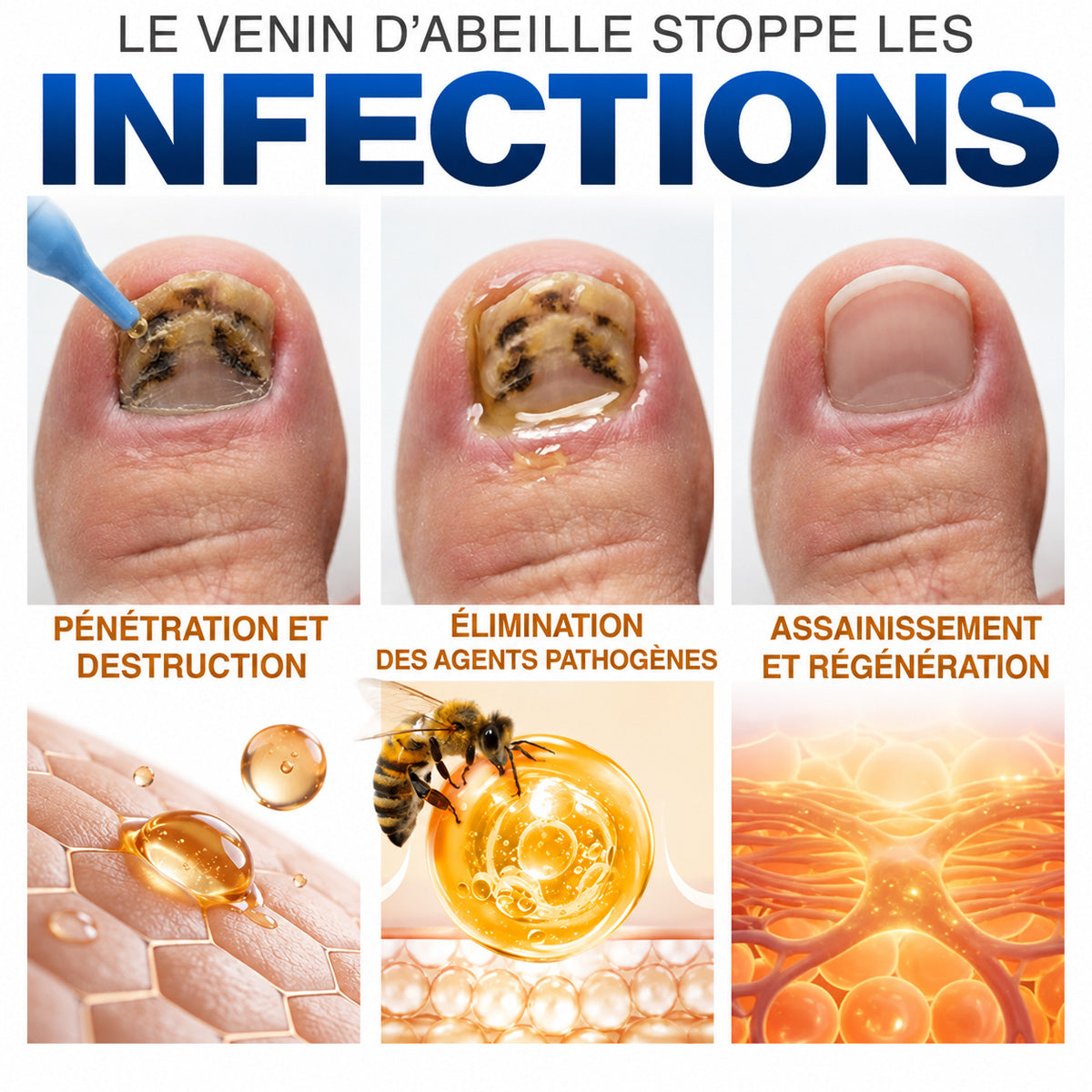 🇫🇷 Turonu® FungiFree 🐝 Soin Intensif contre les Mycoses, les Ongles Jaunis, Épais et Cassants ✨