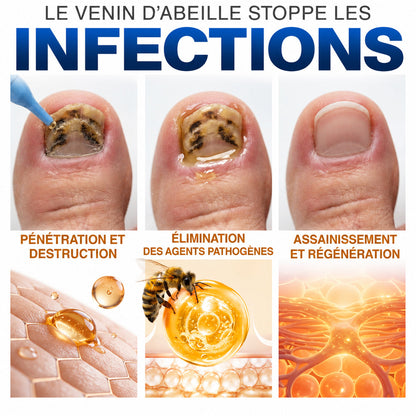 🇫🇷 Turonu® FungiFree 🐝 Soin Intensif contre les Mycoses, les Ongles Jaunis, Épais et Cassants ✨