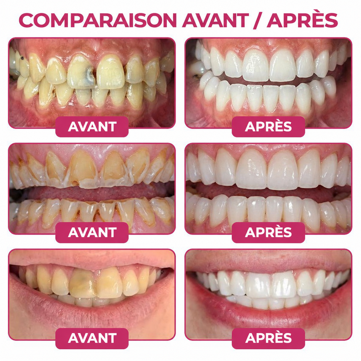 🇫🇷GarageLine® DenPerm🏆— Gel Réparateur de l’Émail Naturel pour Caries, Dents Sensibles & Émail Fragilisé