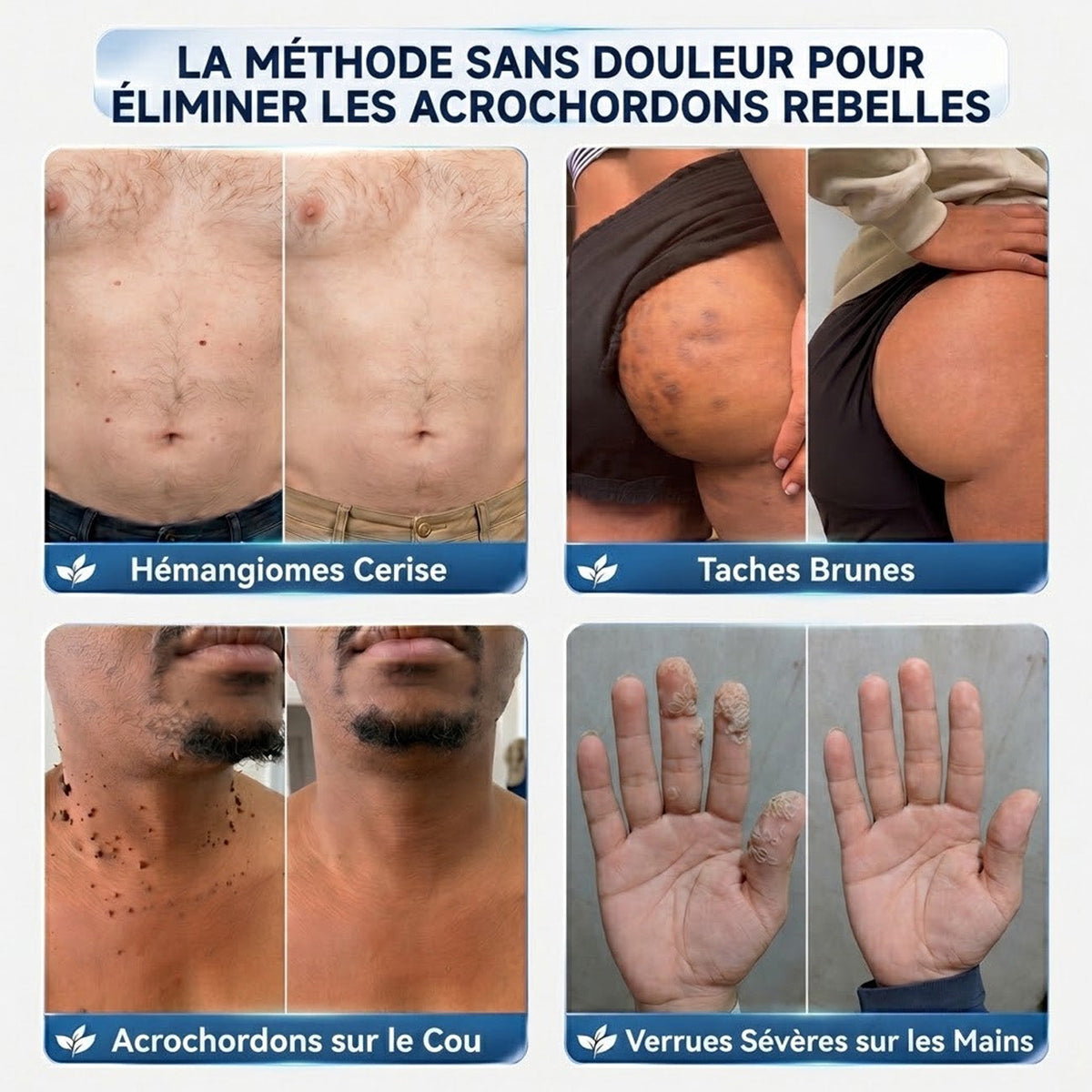 🖤CureVivo® Crème 7‑Jours pour éliminer les marques cutanées et les taches (Formule indolore – Sans cicatrices)🤗