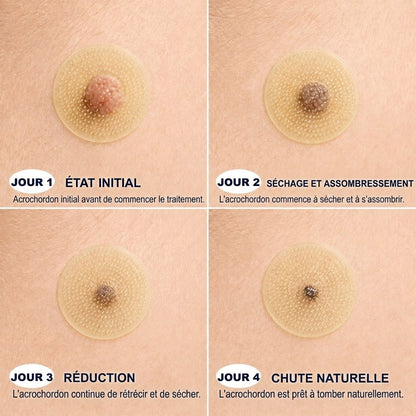 📣 Boutique officielle phare | CureVivo® 🐝 Patch à micro-aiguilles au venin d'abeille (pour les verrues, les taches de vieillesse et les imperfections)🐝
