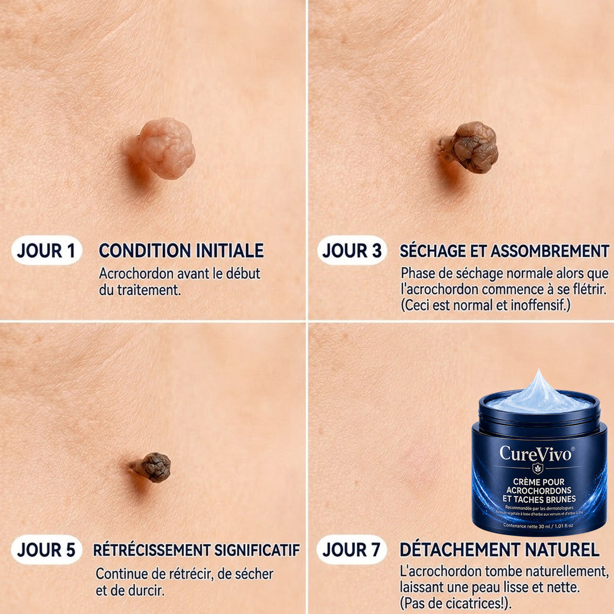 🖤CureVivo® Crème 7‑Jours pour éliminer les marques cutanées et les taches (Formule indolore – Sans cicatrices)🤗