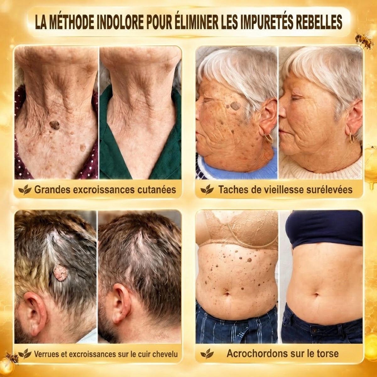 📣 Boutique officielle phare | CureVivo® 🐝 Patch à micro-aiguilles au venin d'abeille (pour les verrues, les taches de vieillesse et les imperfections)🐝