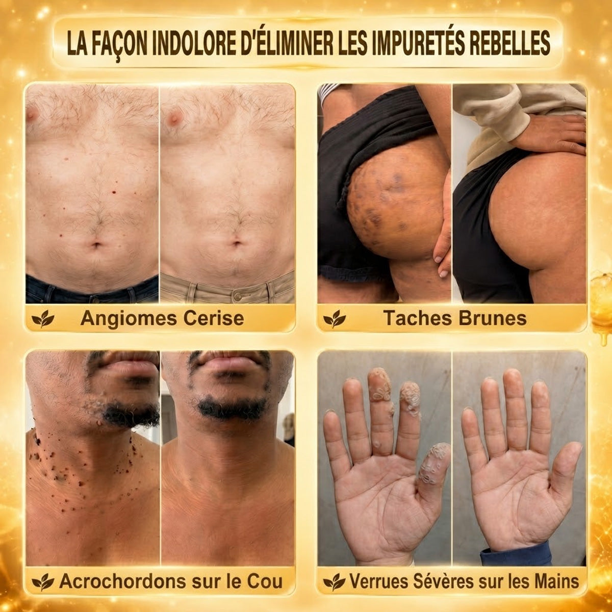 📣 Boutique officielle phare | CureVivo® 🐝 Patch à micro-aiguilles au venin d'abeille (pour les verrues, les taches de vieillesse et les imperfections)🐝