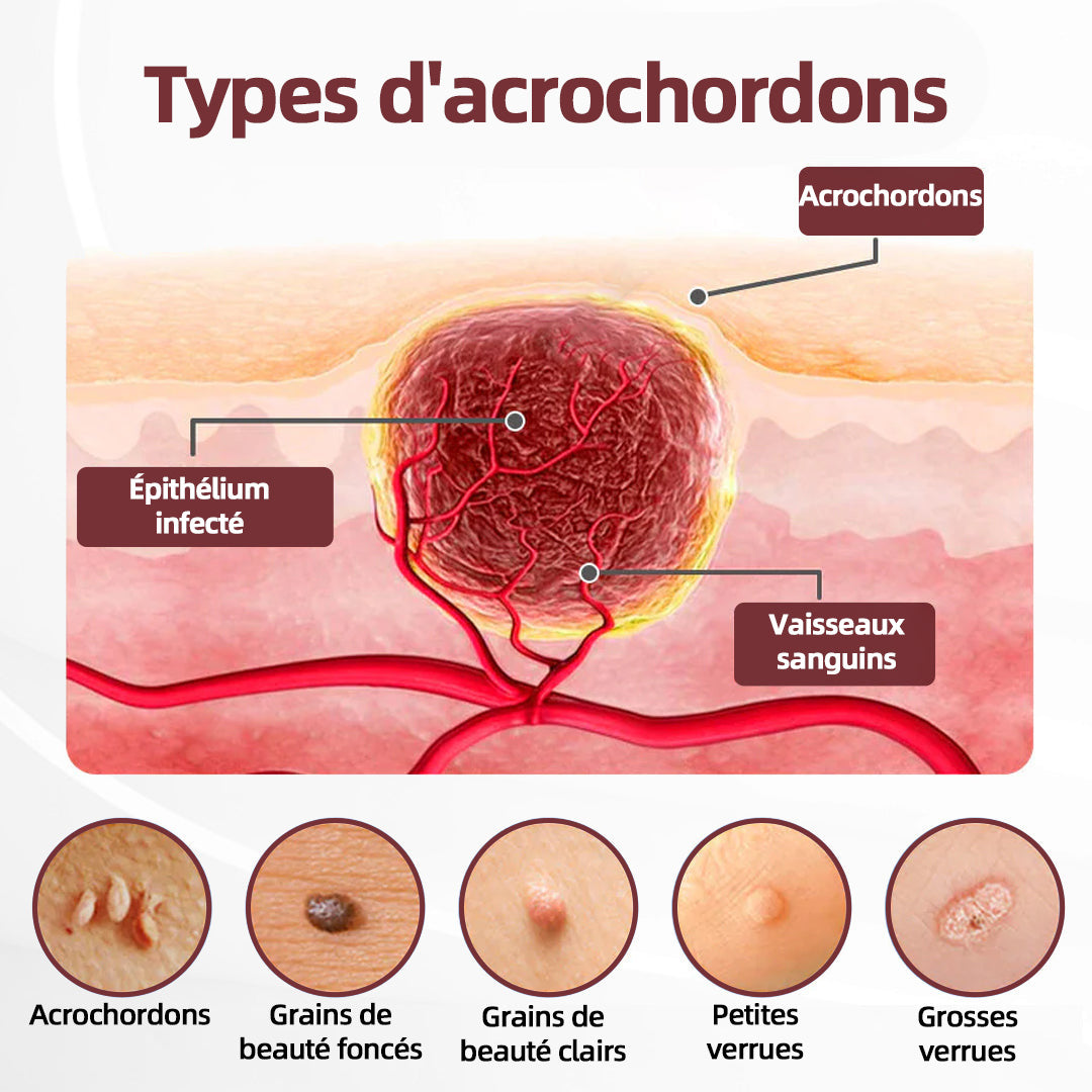 CureVivo® KeraErase 50 OFF